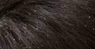 Try washing your hair every other day instead, using a dry shampoo if needed on the days between. Dandruff Vs Dry Scalp Causes Treatment And Prevention