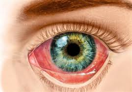 Image result for Gonococcal Conjunctivitis