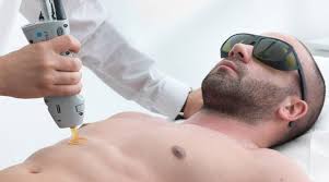 In some cases, it's a bit too effective. Laser Hair Removal For Men Chic Med Aesthetic Clinics