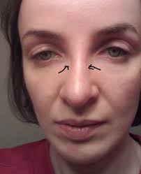 When buying eyeglasses, there is the cost of the frames and. Persistent Indentations On Nose Bridge After Having Sunglasses On For Just 5 Seconds 2 Weeks After Rhinoplasty Photos