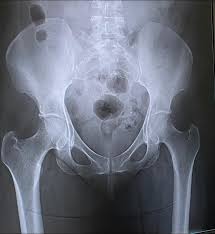 Image result for Hip XRay