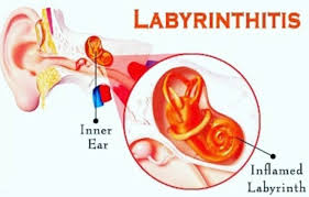 Image result for Bacterial Labyrinthitis