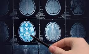 É uma das patologias mais comuns do sistema nervoso central e a principal causa de incapacidade neurológica nos adultos jovens depois dos acidentes de viação. A Importancia De Um Exame De Ressonancia Magnetica Para Esclerose Multipla