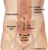 Spinal Fusion Anterior Lumbar Interbody Fusion Alif Spinal Fusion Spinal Fusion Surgery Spinal