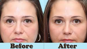 She's holding up well, but there are eye bags that give her away. Eye Bag Removal Causes Creams Treatments Home Remedies