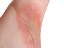 Image result for Intertrigo under breasts