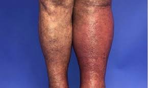 What is cellulitis