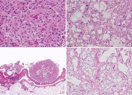 Here are some of the common features of epithelioid mesothelioma: Unusual Histologic Features Of Epithelioid Mesotheliomas A The Large Download Scientific Diagram