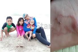 Diet rendah lemak, tinggi karbohidrat; Sakit Urat Selepas Ke Pantai Siap Mengurut Rupa Rupanya Cacing Berzumba Dalam Kaki Jangan Ulangi Apa Yang Wanita Ini Buat Viral Mstar