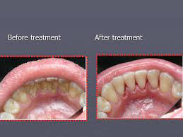 Maybe you would like to learn more about one of these? Lecture 2 Dental Calculus And Plaque Methods Of Removing Ppt Download