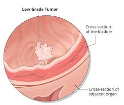 Bladder Tumors