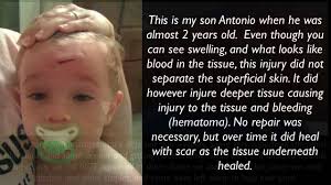 Daily cleaning is generally necessary to prevent infection and a doctor or nurse will show you how to clean and redress your wound. Does It Need Stitches Youtube