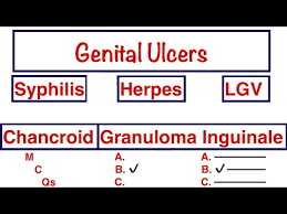 Image result for chancroid