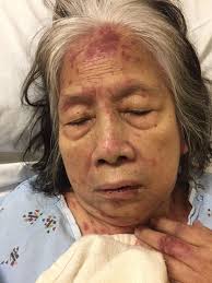 Steven-Johnson Syndrome