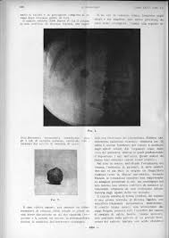 Particularitati de ingrijire a bolnavului cuadenom de prostata. Poze Cu Adenom De Prostata