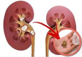 Nu disperați, dacă ați găsit nisip în rinichi. Top 11 Ceaiuri Pt Rinichi Infectii Urinare Pietre Si Nisip Tratament