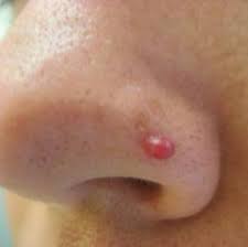 There are no risk factors for the condition Cherry Angioma Removal Dermis Health