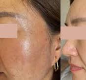 Skin Booster Injection Before and After Results: Real ...