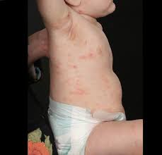 Image result for scabies human children