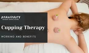 Cupping Therapy: Working and Benefits - Renuvenate