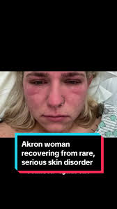 Kim Cannon just spent 15 days in a burn unit, unable to move ot eat due to  Stevens-Johnson syndrome. It’s a rare, serious skin condition that can be  caused by an allergic reaction to medication. #skin ...