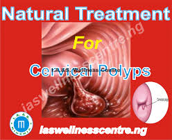 Cervical polyps are small fingerlike growths originating from the mucosal surface of the cervix. Cervical Polyps And It S Natural Treatment In Nigeria I A S Wellness Centre