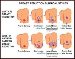 I'm thinking about breast reduction, too. Breast Reduction In Kano Medcontour Book Now