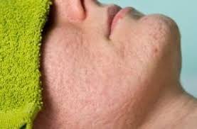 Ice Peak Scar Type Patchy Skin Chemical Peel Effective Acne Treatment