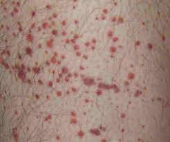 In adults, the disorder is often long term. Purpura Types Causes Diagnosis And Treatment