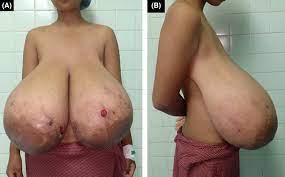 Virginal breast hypertrophy in a 14‐year‐old girl: A case report - Pokhrel  - 2021 - Clinical Case Reports - Wiley Online Library