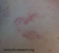 Early ibc symptoms may include persistent itching and the appearance of a rash or small irritation similar to an. Breast Cancer Rash Cancerwalls