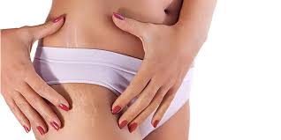 Scrub the mixture on the part of your. How To Remove Stretch Marks On Buttocks Thighs Hips