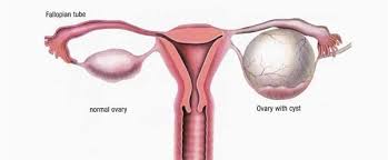 Sebenarnya, ada banyak sekali ide usaha makanan yang menguntungkan di sekitar kita. Atiehilmi Com Malaysian Lifestyle Blogger Makanan Yang Harus Dielakkan Oleh Pesakit Cyst Dan Fibroid