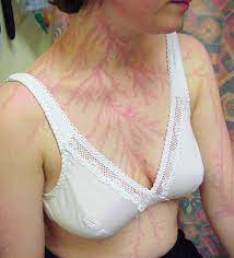 The realistic lightning tattoo designs are mostly lightning bolt tattoos made with multicolour. Here S What Scars Of Being Struck By Lightning Look Bored Panda