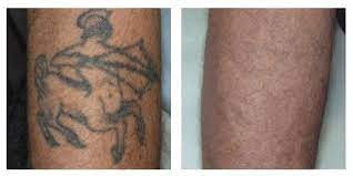 Some people say that the procedure feels similar to getting a tattoo, but for a much shorter duration. Laser Tattoo Removal Arizona Perfect Skin Laser Center Llc Az