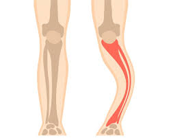 Tumbuh tulang yang tajam pada tulang kalkeneal. Penyakit Paget Gejala Penyebab Pengobatan Dll Doktersehat