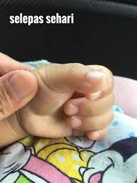 Bagaimana memilih krim pemutih yang baik untuk kulit ketiak? Be Positive Be Healthy Be With Shaklee Kulit Bayi Seumur Setahun Lebih Melecur Akibat Terkena Eksos Motor Dirawat Dengan Krim Herbal Blend