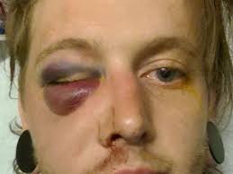 Fundraiser for Brandon Arnett by Michael Burroughs : Help Brandon pay for  orbital surgery