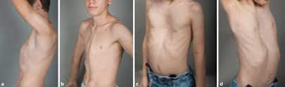 Definition die trichterbrust ist eine angeborene, meist auf einer fehlerhaften entwicklung beruhenden deformität des brustkorbes. Therapie Der Angeborenen Thoraxfehlbildungen Ruckblick Und Ausblick Springerlink