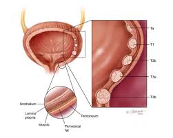When the storage capacity of the bladder is met, we feel the urge to pass urine. Urinary Bladder Cancer Treatment In Bangalore India Kidney Stones