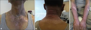 Image result for Photodermatitis