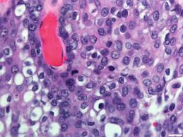 Mucoepidermoid carcinoma is composed of an admixture of 3 cell types: Pathology Outlines Mucoepidermoid Carcinoma