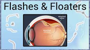This posterior vitreous detachment is the most common cause of floaters. Flashes Floaters A Sign Of Retinal Detachment Youtube