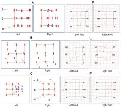 Diplopia Charts Of Computerized Diplopia Test And Hess