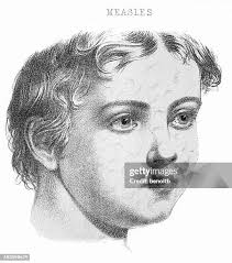 1 270 Measles Child Stock Photos, High-Res Pictures, and Images