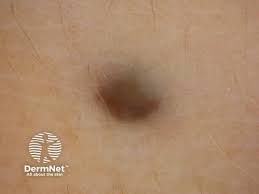 Image result for Blue Nevus
