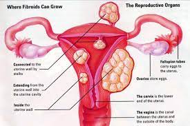 In premenopausal women, fewer than 1% of new growths on or in an ovary will turn out to be cancer. Natural Treatments For Fibroids Healthzone Tips Ovarian Cyst Uterine Fibroids Fibroids Treatment