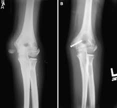 Me is the most common cause of medial elbow pain. Acute Avulsion Fractures Of The Medial Epicondyle While Throwing In Youth Baseball Players A Variant Of Little League Elbow Journal Of Shoulder And Elbow Surgery