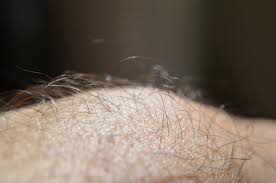 Nazarian notes that green tea contains a high level of natural. 10 Effective Ways To Get Rid Of Ingrown Leg Hair Hubpages