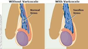 Image result for Varicocele